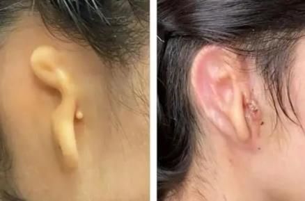 活组织制成的3D打印耳朵移植成功图.jpg